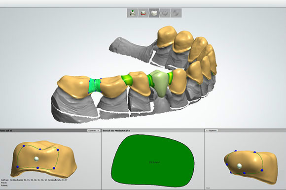 Hochwertiger Zahnersatz CAD/CAM