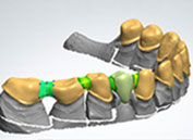 Hochwertiger Zahnersatz CAD/CAM